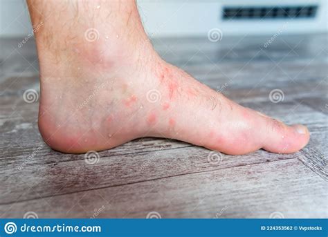 Close Up On Many Mosquito Bites On Menand X27s Foot Skin Stock Photo