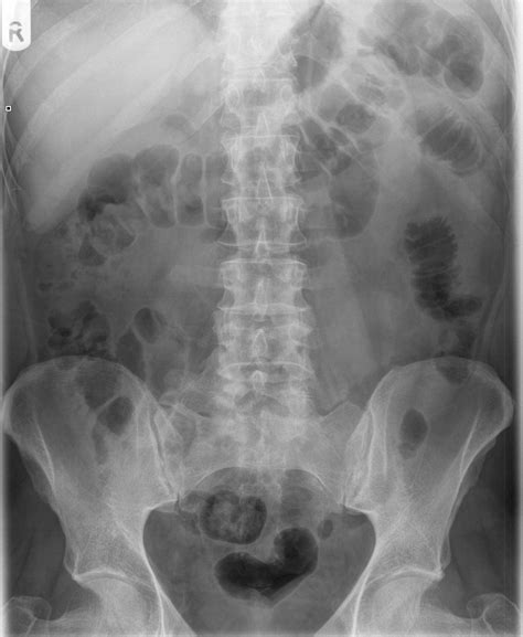 Diverticulitis With Bladder Wall Thickening Image