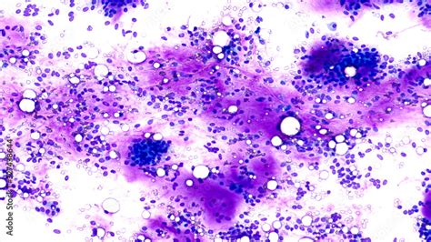 Fine Needle Aspiration Fna Cytology Of Pleomorphic Adenoma Mixed