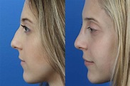 Best Rhinoplasty and Nose Jobs in New York City, NY | Dr. Philip Miller