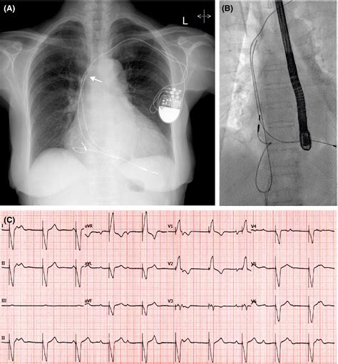 Pacemaker Syndrome Due To Atrial Lead Fracture Nguyen 2020