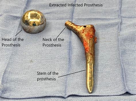 Joint Replacement Infection Surgery Management Complete Orthopedics