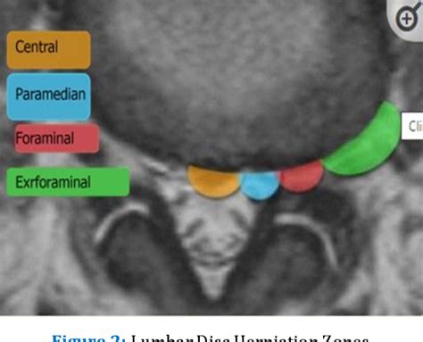 Figure 2 From Far Lateral Lumbar Disc Herniation In The Emergency