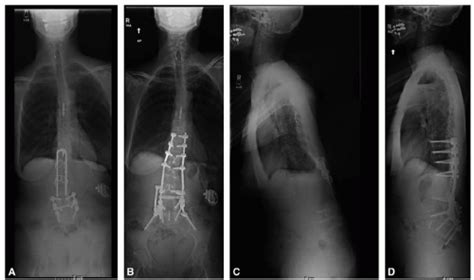 Lumbar Pedicle Subtraction Osteotomy Musculoskeletal Key