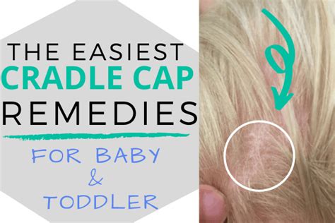 Cradle Cap Home Remedies To Get Rid Of It Oh Baby Love