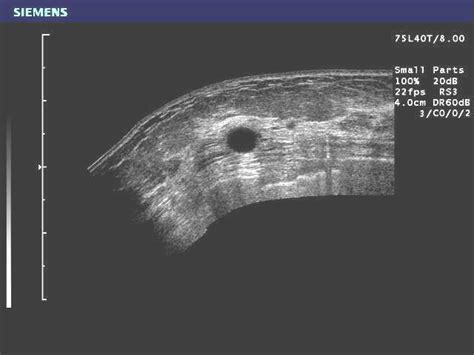 4 An Ultrasound Image Of A Simple Breast Cyst Dark Object Within The