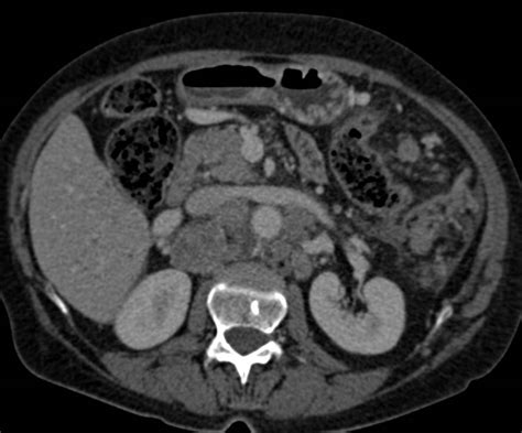 Lymphoma With Extensive Adenopathy And Splenic Infiltration Spleen