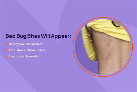 What Are Bed Bugs Bites Dangerous For Treatment And P