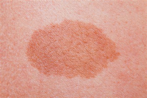 Higher C Reactive Protein Predicts Worse Survival In Melanoma Cancer