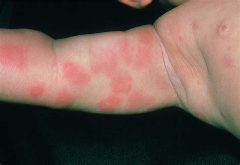 Rash On Baby S Arm Due To Food Allergy Photograph By Dr P Marazzi