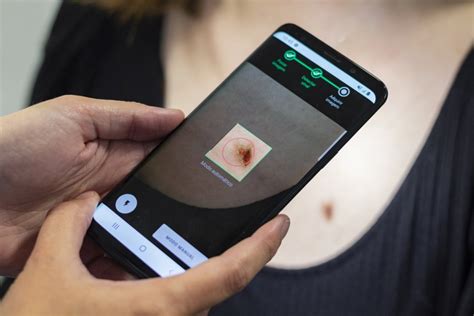 Ai Powered App To Speed Up Skin Cancer Diagnoses • Healthcare In