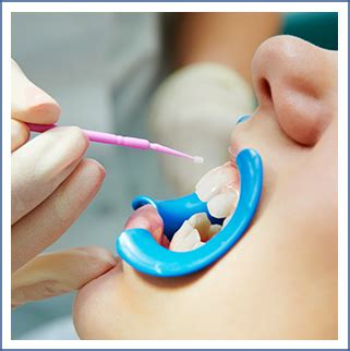Fluoride Treatment - Lynnfield Dental Associates