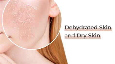 Difference Between Dehydrated Skin And Dry Skin Suganda Skincare