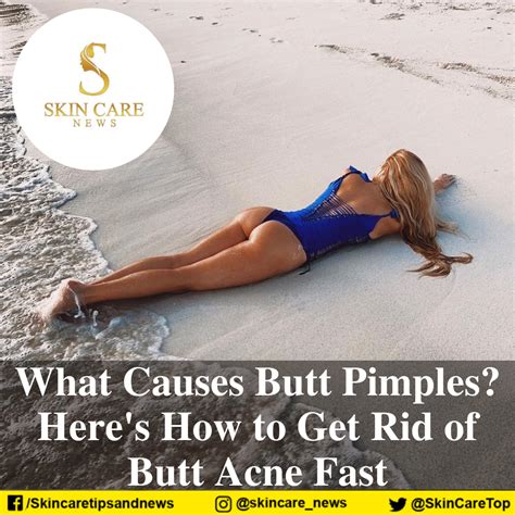 What Causes Butt Pimples Here S How To Get Rid Of Butt Acne Fast