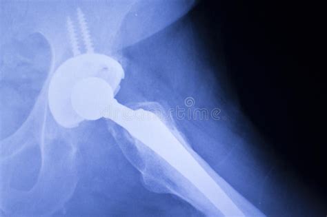 563 Hip Replacement Stock Photos Free And Royalty Free Stock Photos