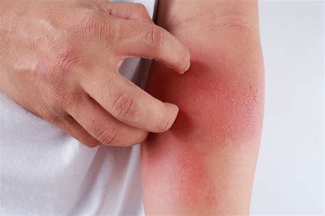 All You Need To Know About Eczema