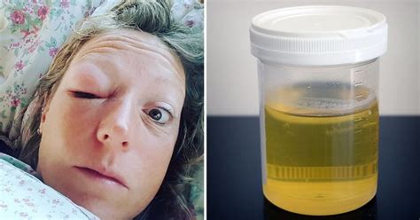 Woman Drinks Two Glasses Of Urine A Day After It Helped Heal Her Eye