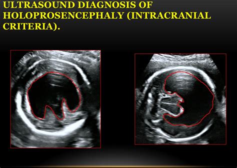 Holoprosencephaly Hpe Diagnostic Medical Sonography 4d Ultrasound