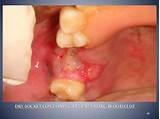 Tooth Extraction Pain Management