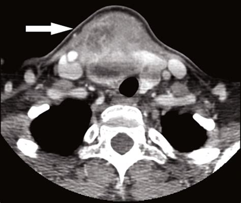 Contrast Enhanced Ct Scan Focused On The Right Thyroid Nodule That