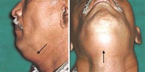 Deep Neck Infection Causes Symptoms Diagnosis Treatment And Prognosis