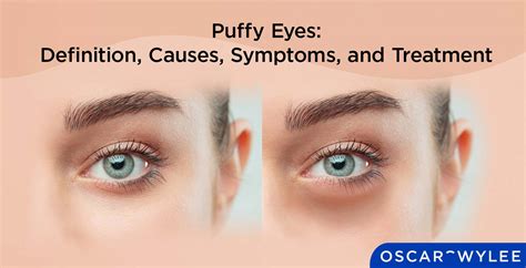 Puffy Eyes Definition Causes Symptoms And Treatment