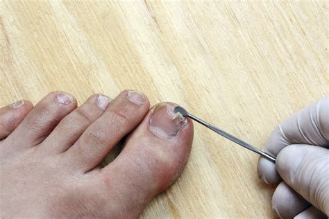 Toenail Cracking Down The Middle Heres Why Split Toenails