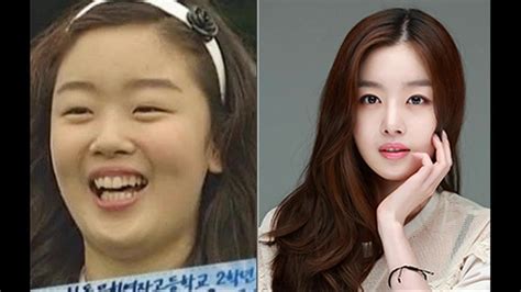 Korean Plastic Surgery Before And After Photos Youtube