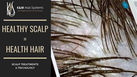 Healthy Scalp Healthy Hair Trichology Youtube