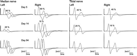 Conduction Block And Axonal Degeneration Co Occurring In A Patient With