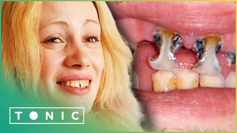 Decaying Teeth Need Medical Care Britains Worst Teeth Tonic Youtube