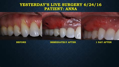 Receding Gums Surgery Before And After