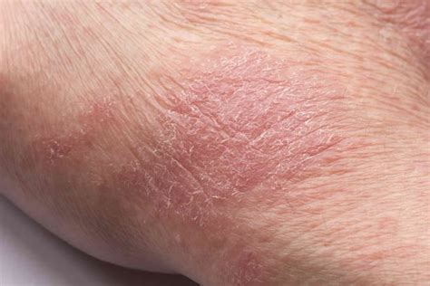 Man Presents With Diffuse Pruritus Atopic Dermatitis Challenge Center