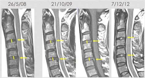 C4 5 Disc Herniation And C5 6 Disc Bulge 53 Off