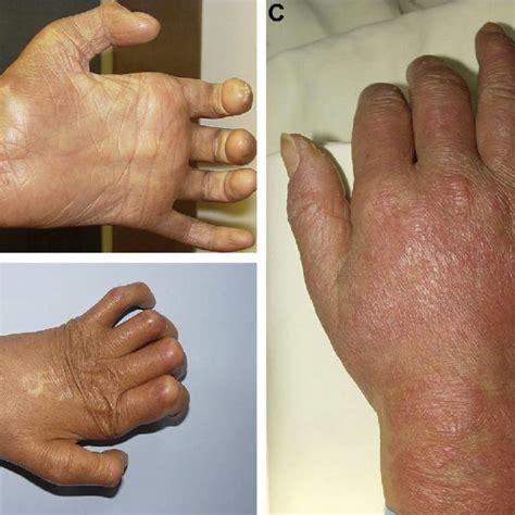 Bilateral Hand Lesions Of Our Patient Ab Muscle Wasting And Claw