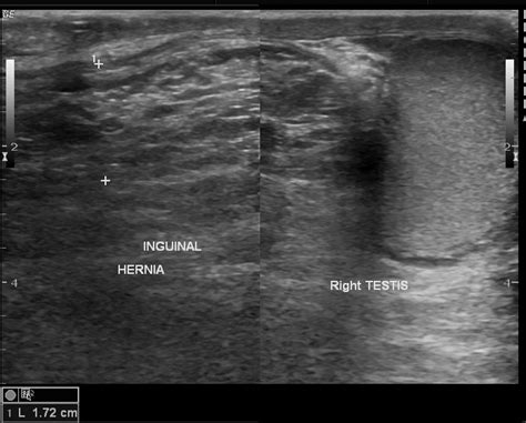 Inguino Scrotal Hernia Image