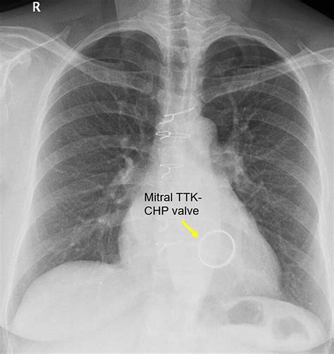 Mitral Valve Chest X Ray