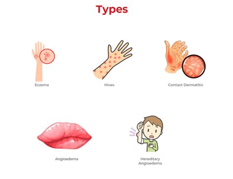 Skin Allergy Types Causes Symptoms And Prevention Lal Pathlabs