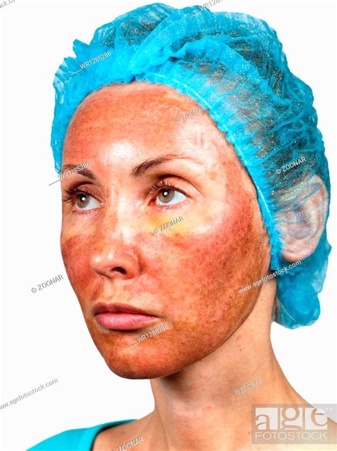 Skin Condition After Chemical Peeling Tca Stock Photo Picture And