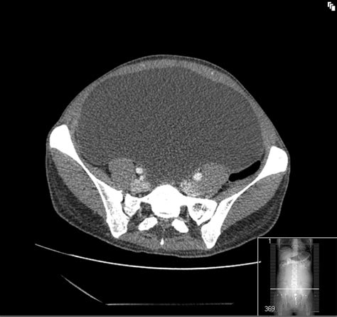 Giant Mesenteric Cyst A Rare Cause Of Abdominal Distension Diagnosed