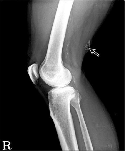 Lateral Radiograph Of Right Knee Show Calcified Lesion Arrow On