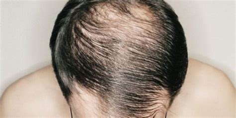 6 Reasons Why Men End Up Losing Their Hair Demotix