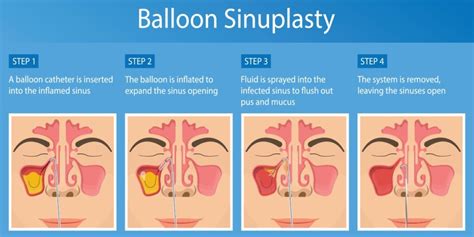 Balloon Sinus Procedures Ohio Head And Neck Surgeons