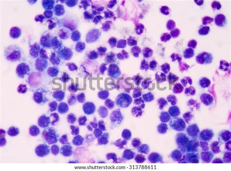 White Blood Cells Peritoneal Fluid Unfocused Stock Photo Edit Now