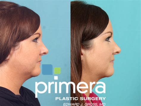 Buccal Fat Removal Before And After Pictures Case 599 Orlando