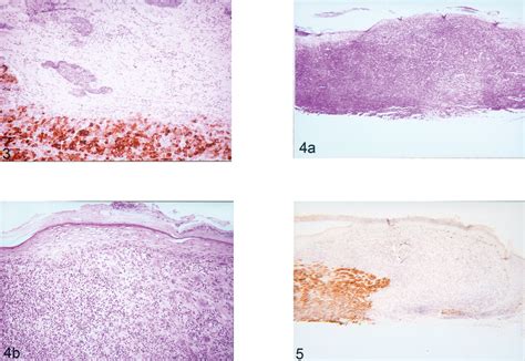 Amelanotic Malignant Melanoma Two Collision Tumors Presenting As Basal