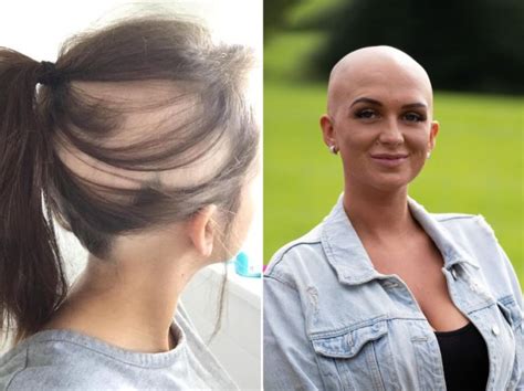 Alopecia Sufferer Sick Of Hiding Bald Patches Shaves Her Head Metro News