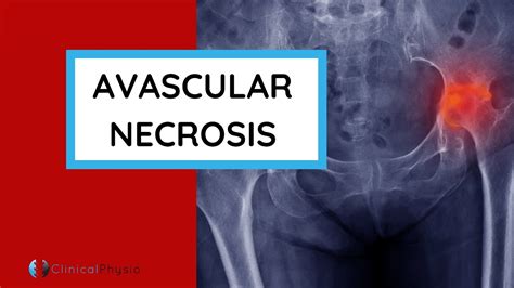 What Is Avascular Necrosis Avn Why Does It Happen Who Gets It