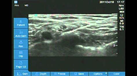 Ultrasound Guided Supraclavicular Nerve Block Youtube