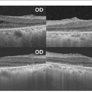 A Cystoid Macular Edema CME Shown By Spectral Domain Optical Download Scientific Diagram